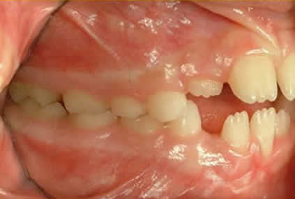 DEGLUTIZIONE ATIPICA sx prima